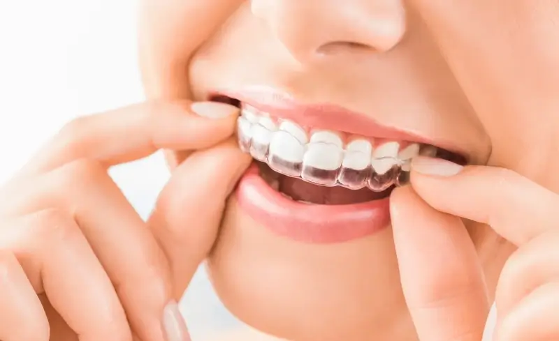 Invisalign ile trwa leczenie?