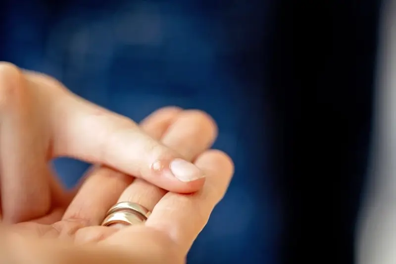 Co wywołuje kurzajki?